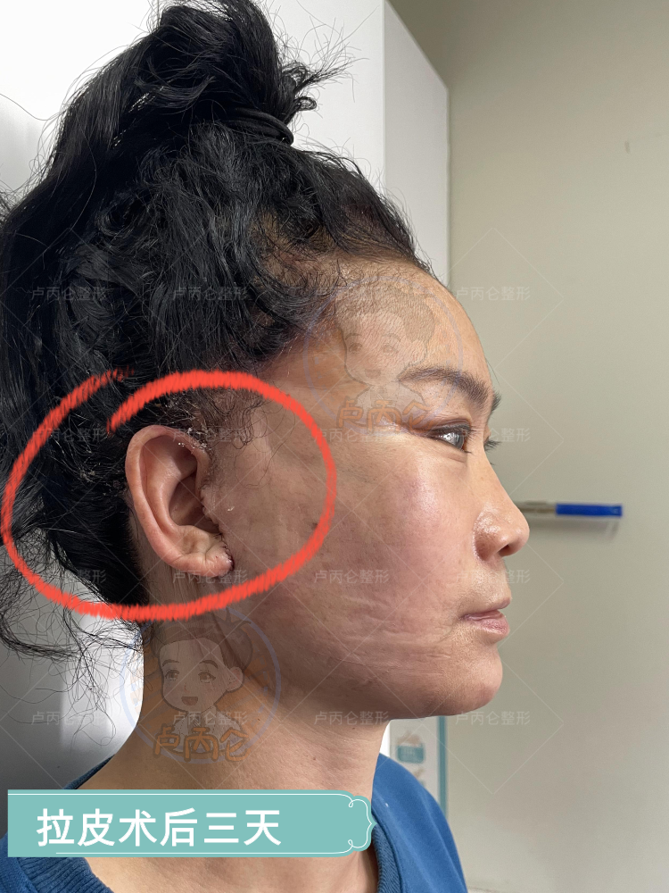 拉皮除皱手术有哪些风险和后遗症