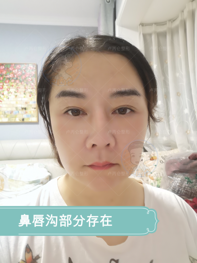 当然即使拉皮拉得再紧,鼻唇沟和口角囊袋也还是会有一点,鼻唇沟是小