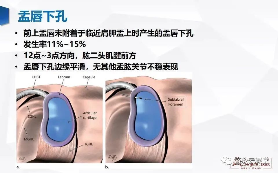 一文掌握肩关节盂唇解剖及变异