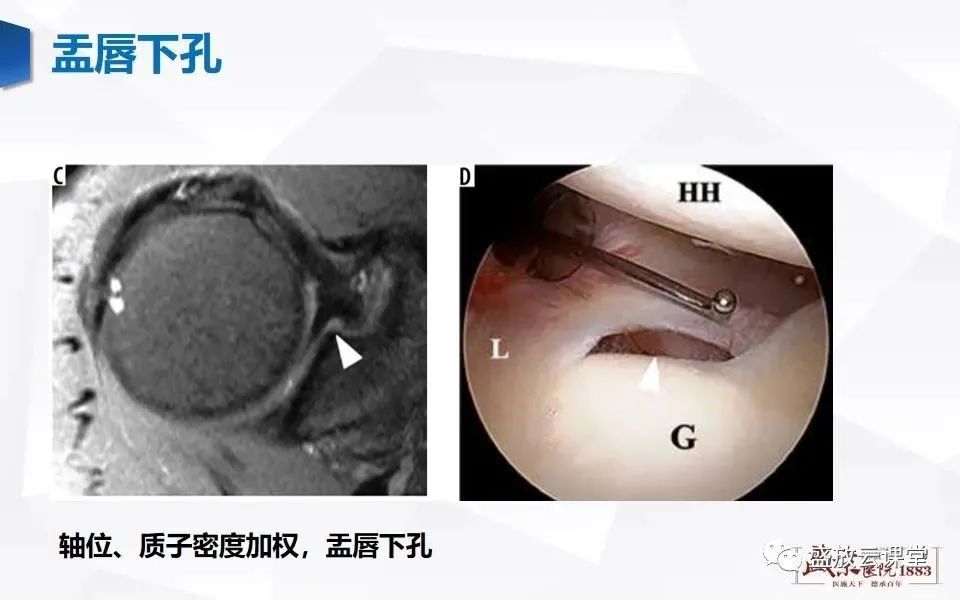 一文掌握肩关节盂唇解剖及变异