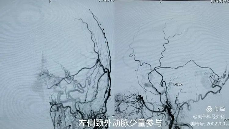 可以看到直窦内逆向流动右侧颈外动脉造影,也可看到扩张的静脉球瘤和