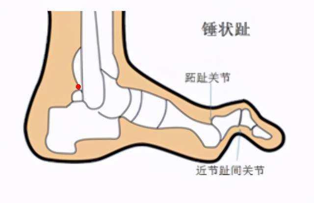 足趾过长影响美观足趾过长穿鞋过度挤压不适足趾过长末端出现疼痛,拼