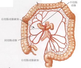 (中结肠动脉缺如,由左结肠动脉大的分支所代替)结肠动脉的变异(右结肠