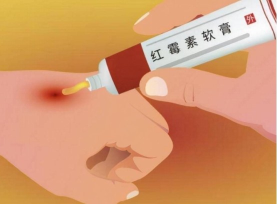 小小红霉素软膏却有多种功效但要注意分清宜忌谨慎用药
