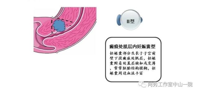 剖宫产瘢痕妊娠的病因及处理