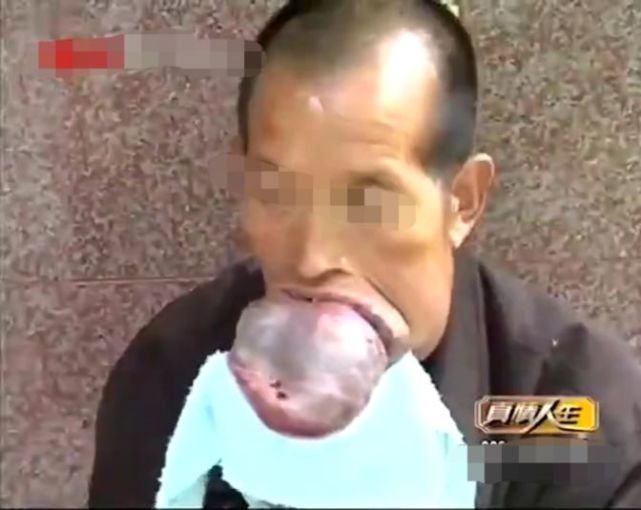 男子被巨舌折磨20年,求医被拒无数次,最后一家医院免费为其治疗