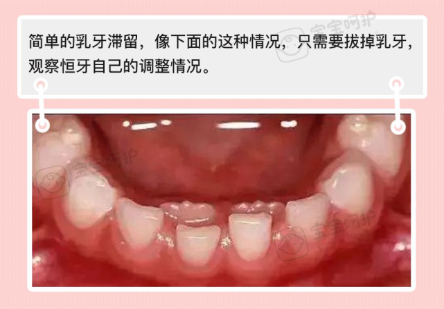 最吓人的"双排牙宝宝"越来越多,只因宝妈做了这件事