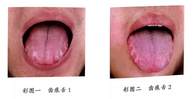 看一眼你的舌头就知道你的脾胃不太好,这8个特征出卖了你