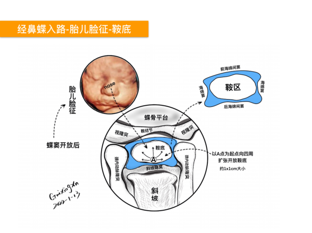 鞍区的精细解剖,鼻腔骨性结构,蝶鞍-垂体窝,蝶骨,willis 环,海绵窦