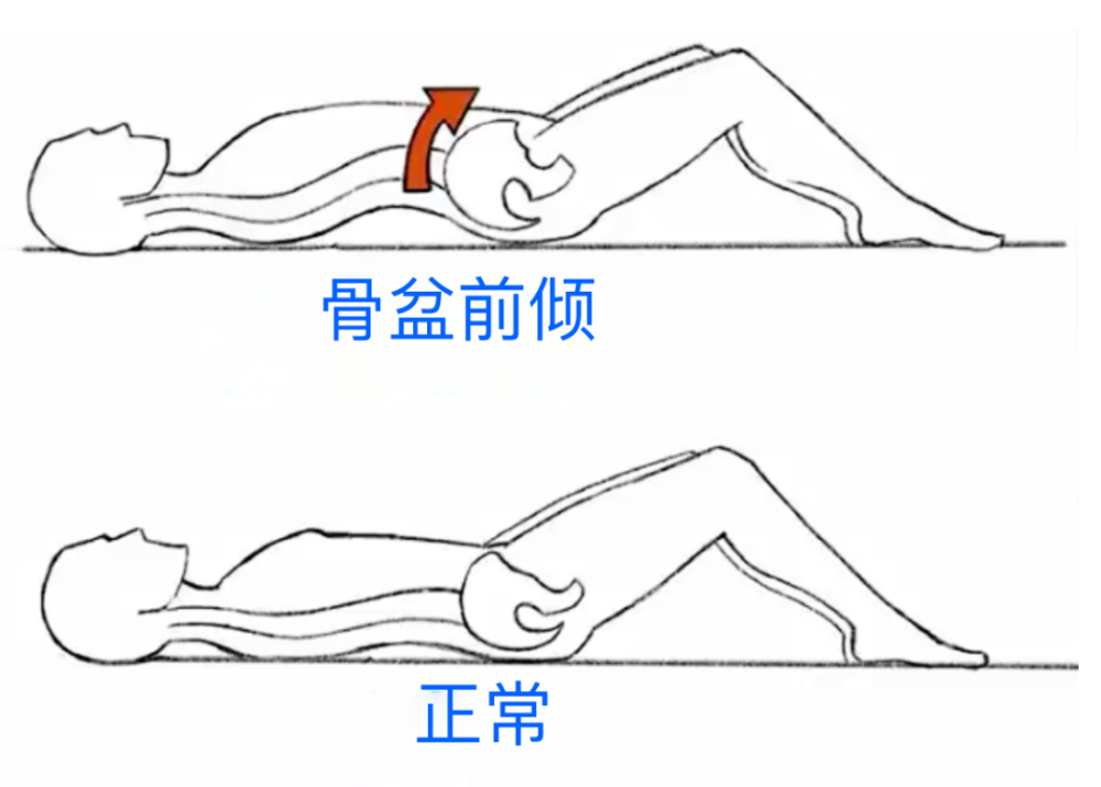 传说中的骨盆前倾究竟对人有多大影响该咋办