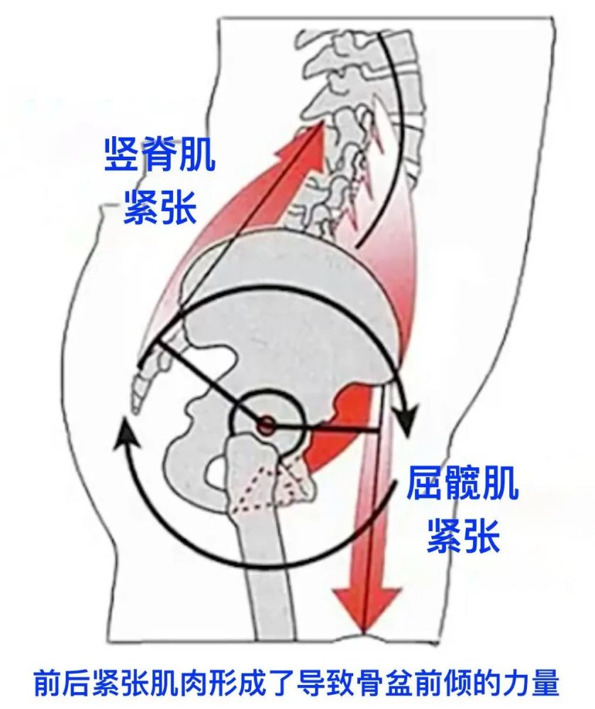 那么这种肌肉异常紧张的情形,就会让骨盆一直都受到一个向前旋转的