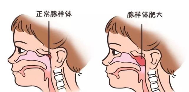 开学在即,孩子"腺样体面容"该如何补救?家长们一定要看!