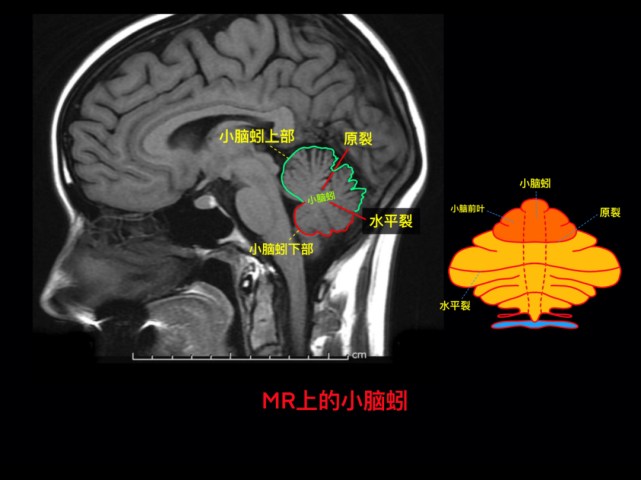 颅脑mr 阅片手绘图|徐桂兴博士