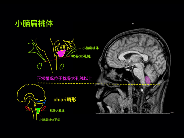 小脑扁桃体脑底前,后中央空间中部前连合-后联合连线天幕角脑沟钩子征