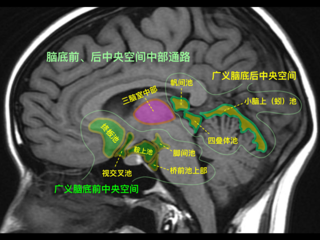 脑底前,后中央空间中部前连合-后联合连线天幕角脑沟钩子征空蝶鞍透明