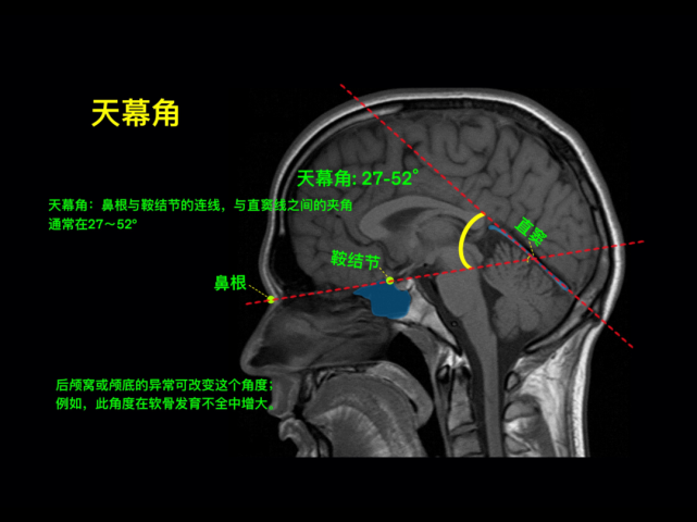 天幕角脑沟钩子征空蝶鞍透明膈小脑幕,大脑镰海绵窦