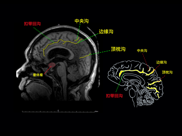 脑沟钩子征空蝶鞍透明膈小脑幕,大脑镰海绵窦