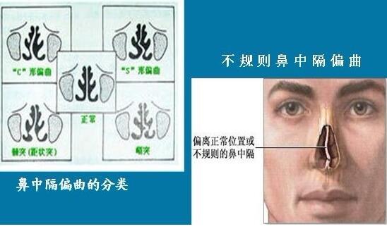 潍坊耳鼻喉专家介绍鼻中隔偏曲是否需要手术治疗