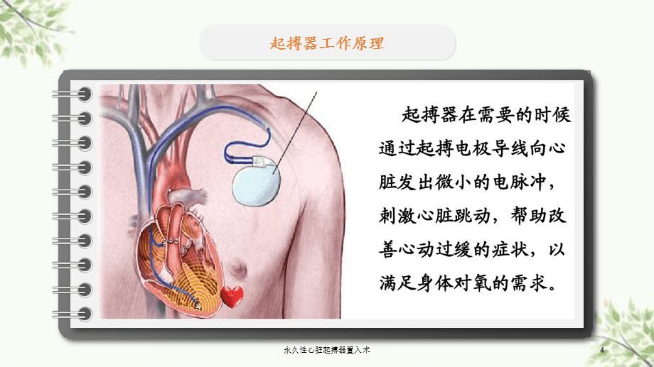 科普揭开心脏起搏器的神秘面纱