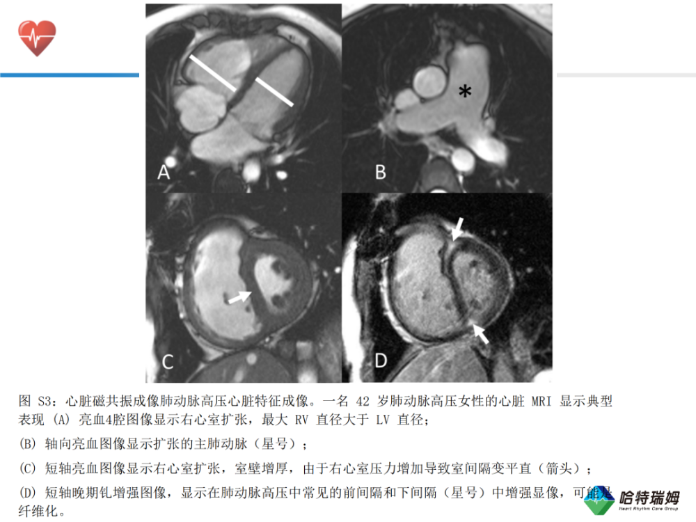 心声肺动脉高压二