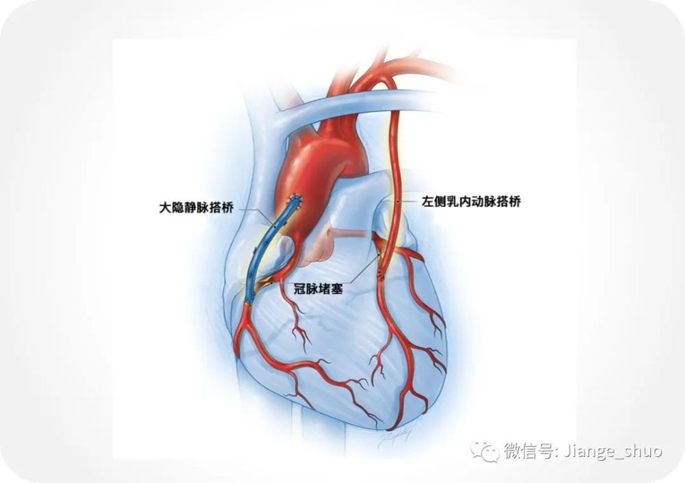 一般可以一次性充分地解决病变,尤其是左侧乳内动脉到前降支的搭桥,是