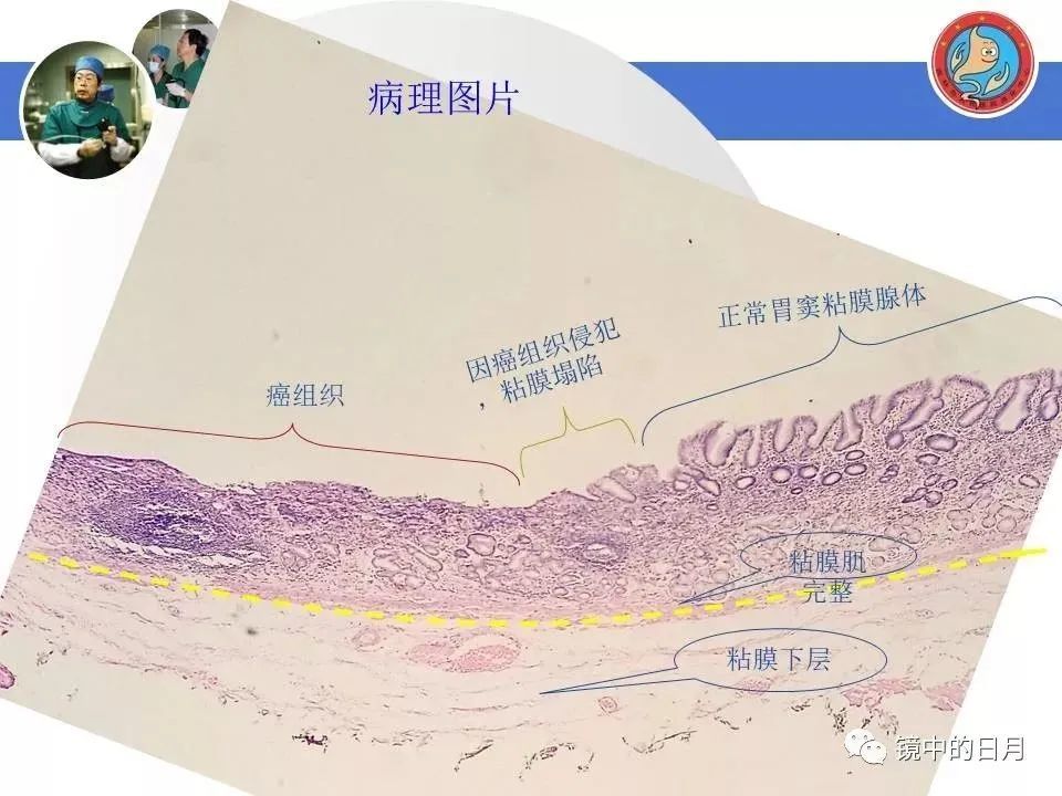 病例详解早期胃癌内镜诊治流程