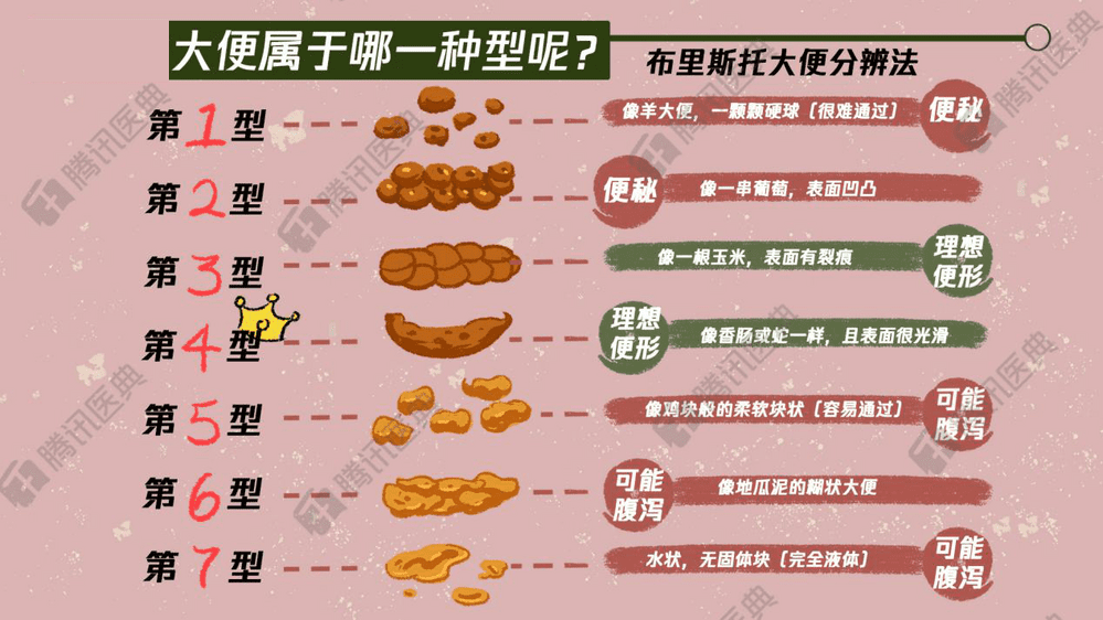 目前描述评估大便形态最有效的是布里斯托大便分类法(简称bsfs.