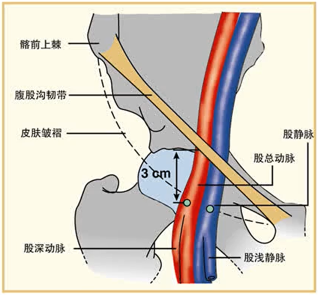股动脉穿刺为何失败可能是这个细节没注意