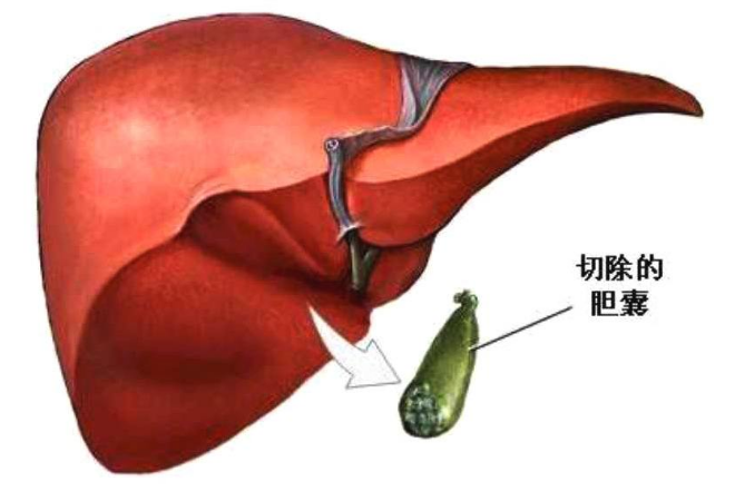 胆囊息肉保胆治疗方法是什么