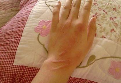 张设表示,一般被猫咬伤或抓伤数日至数周后,伤口附近的皮肤会发红
