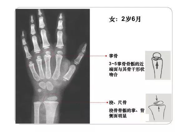 收藏必备丨骨龄图谱