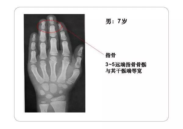 收藏必备丨骨龄图谱