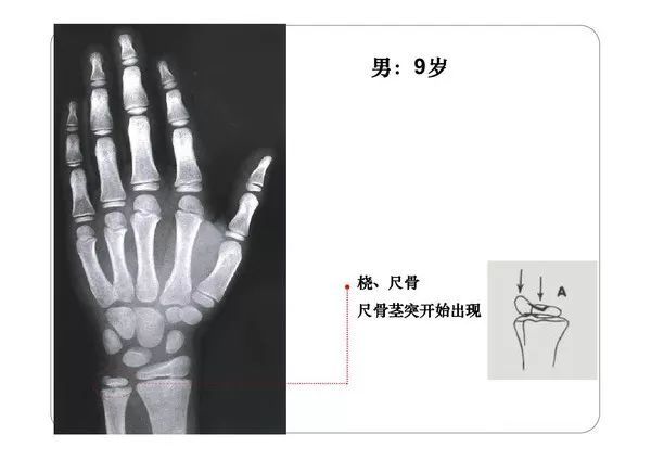 一些国外同仁的文献:上肢(a)和下肢(b)的主要骨的二次(骨骺和骨骺)