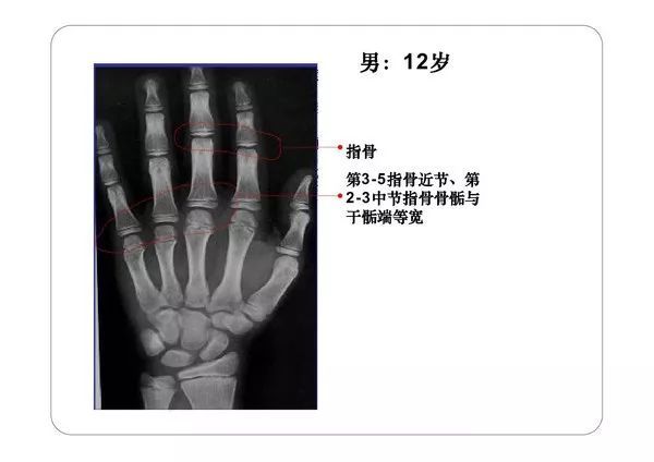 收藏必备丨骨龄图谱