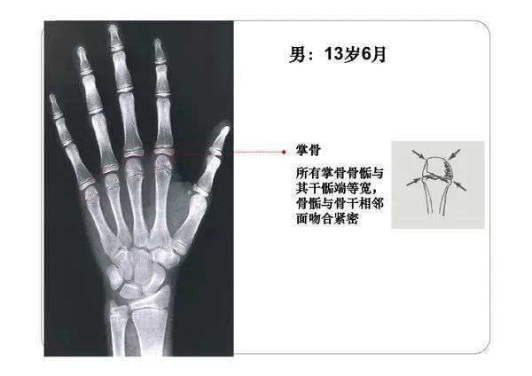 收藏必备丨骨龄图谱