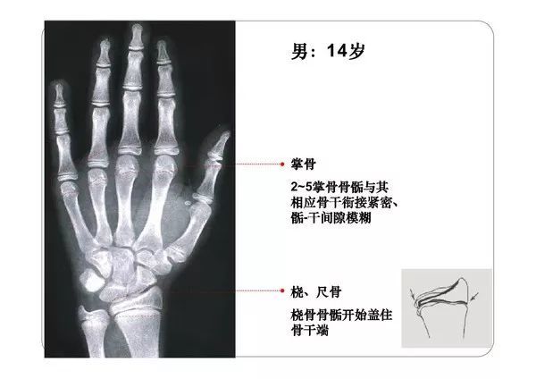 一些国外同仁的文献:上肢(a)和下肢(b)的主要骨的二次(骨骺和骨骺)