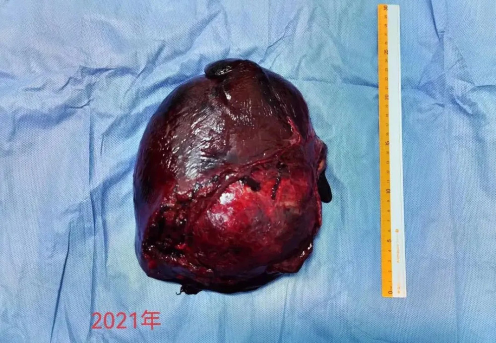 漳州市医院肝胆疝外科再次完成高难度巨大肝癌手术