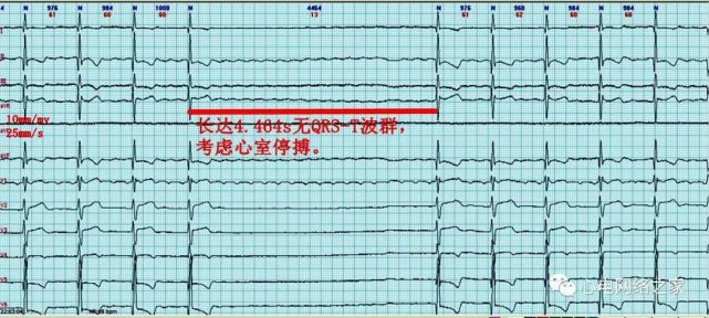 心电图病例分析57心房扑动伴短暂心室停搏