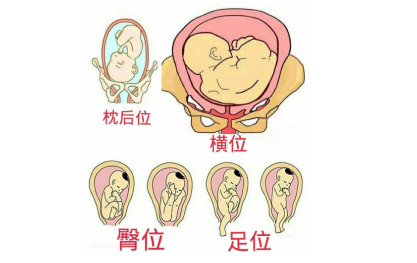 俗语中的坐生和立生就是指胎位,老一辈人口中的坐生,一般指臀位或横位
