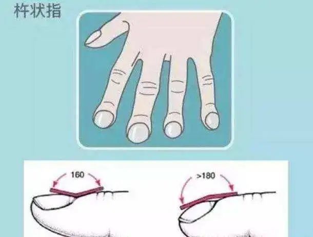什么是杵状指 腾讯网