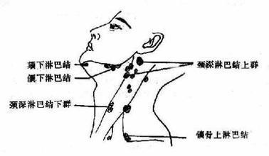 艾灸养生疏通淋巴从根本排毒