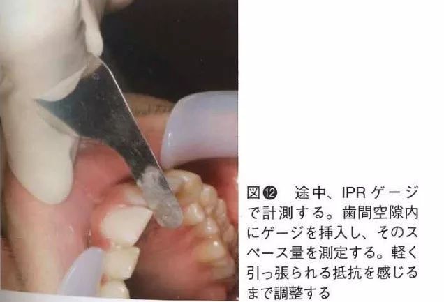 ipr隐形矫正邻面去釉片切drsamoto佐本博
