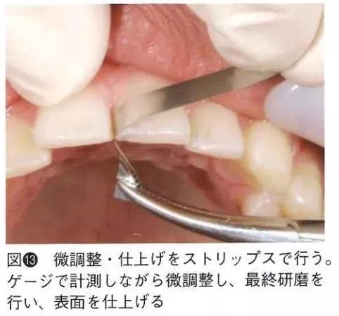 ipr隐形矫正邻面去釉片切drsamoto佐本博