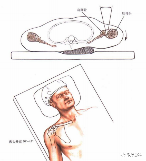 患者体位由于肩关节镜下可以进行肩峰下减压术,所以此入路在治疗肩峰