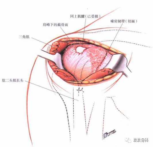 将喙肩韧带连同一骨块从肩峰下面截下,显露深面的肩峰下囊和冈上肌腱