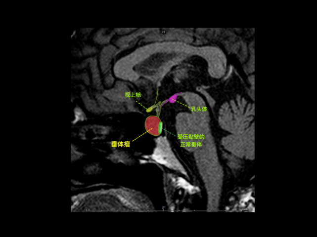 造型肿瘤与周边组织结构关系垂体微腺瘤鞍区常见占位性病变精品推荐