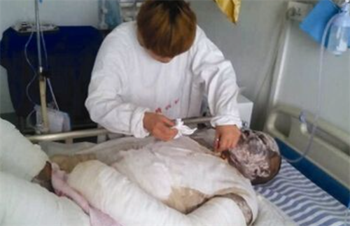 2015年,32岁丈夫掉油锅,全身重度烧伤,妻子割皮也要救他|侯二妮|袁志