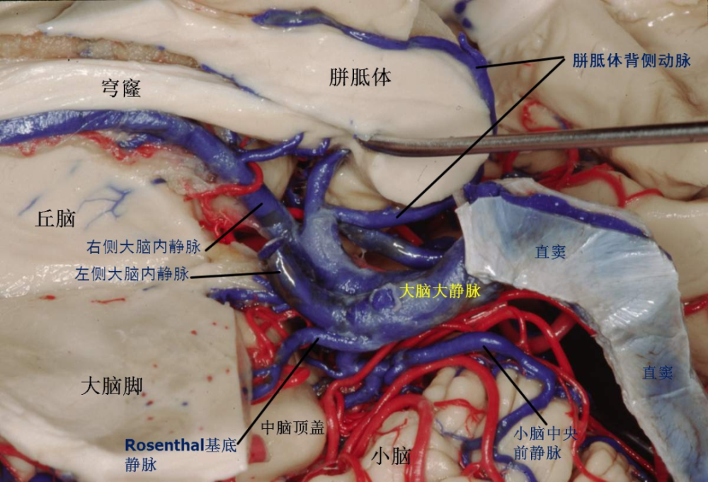 galen大脑大静脉在胼胝体压部由两条大脑内静脉汇合而成,然后向后上呈