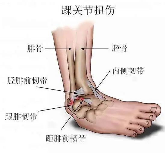 距腓前韧带是一个很重要的韧带,在维持脚踝关节的基本解剖关系中起着