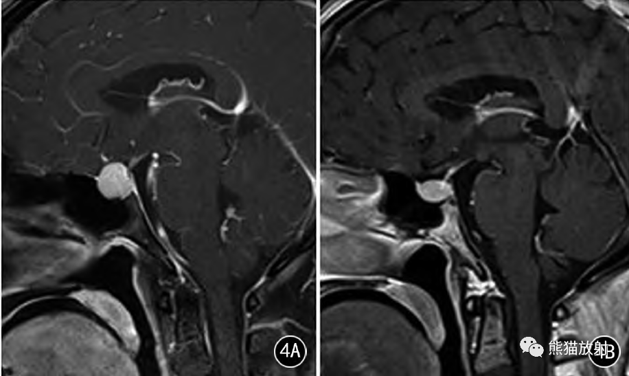 垂体增生丨临床特点及mri表现